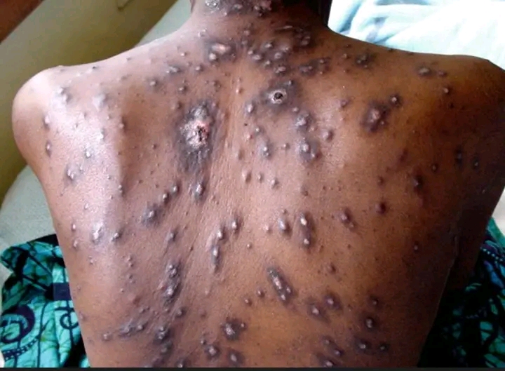 HIV possible symptoms